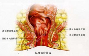 福州肛瘘手术多久后能上班？