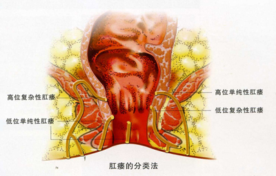 复杂性肛瘘