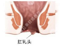 福州肛乳头瘤治疗方法