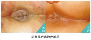 福州混合痔用什么药有效