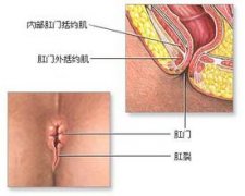 如何检查是不是肛裂