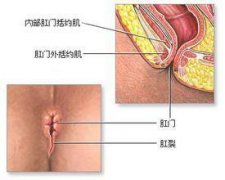 肛裂不及时治疗的危害