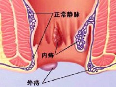 福州治痔疮去哪家医院好