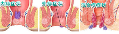 引起混合痔的原因有哪些