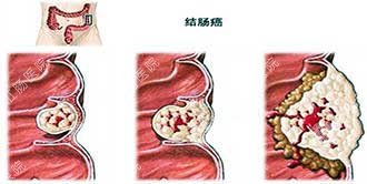 结肠炎是怎么回事？怎么治疗好？