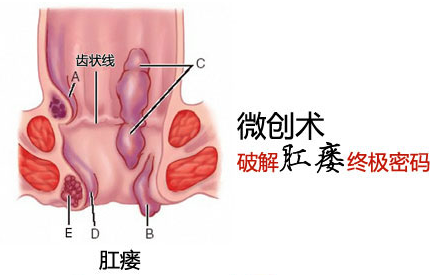 福州肛瘘如何检查?